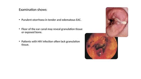 malignant otitis externa diseases of external ear | PPTX