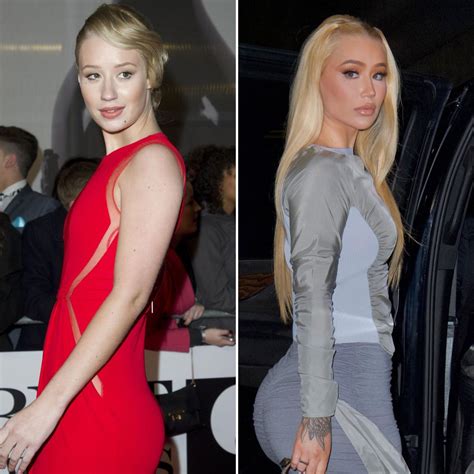 Iggy Azalea Plastic Surgery Explained Before After 2018 Iggy Azalea