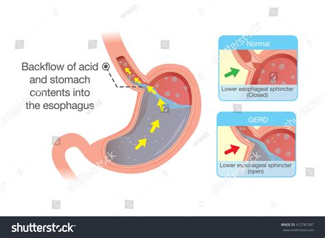 Reflux Acid: Over 2,217 Royalty-Free Licensable Stock Vectors & Vector ...