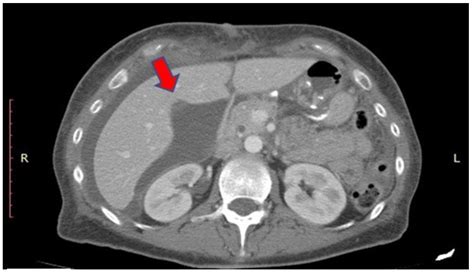 Biliary Leak from Ducts of Luschka: Systematic Review of the Literature