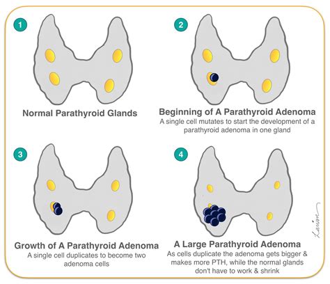 Parathyroid Nodules