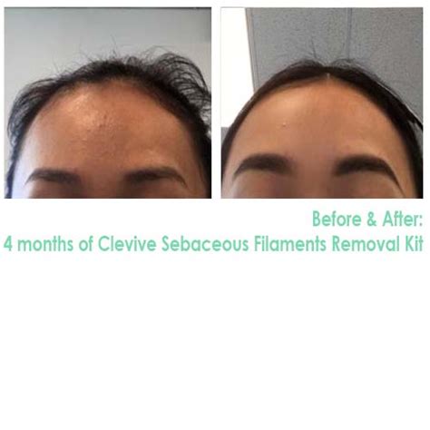 Image result for Sebaceous Filament Extraction