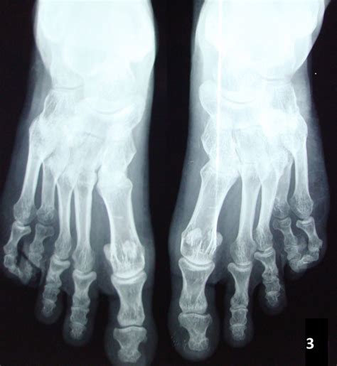 Albright Hereditary Osteodystrophy Features