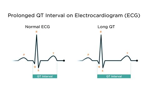 Long QT Syndrome | My Doctor Online