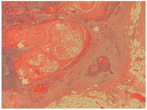 Prophylactic Lymphadenectomy in Patients with Penile Cancer: Is Sooner ...
