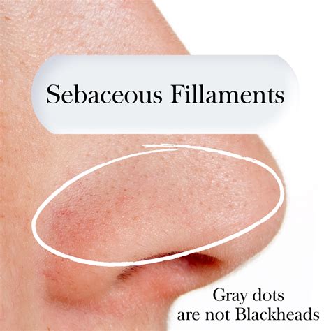 Blackheads vs Sebaceous Fillaments