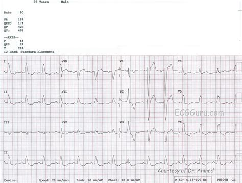 Atrial Enlargement On Ekg
