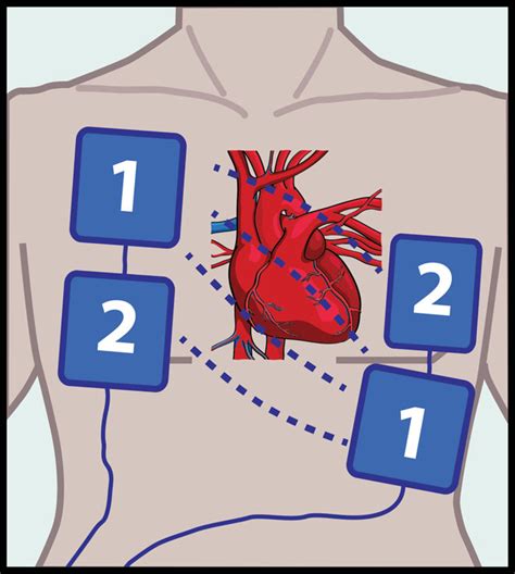 Image result for Synchronized Cardioversion Pad Placement