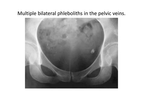 Soft tissue calcification | PPTX