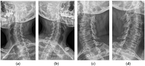 Deep Learning-Based Approaches for Classifying Foraminal Stenosis Using ...