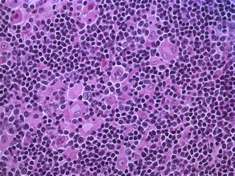 Leukemia Causes & Symptoms | top7stars
