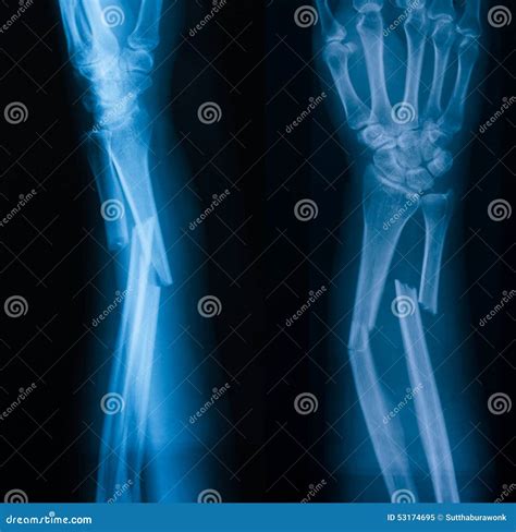 X-ray Image Of Forearm,lateral View, Show Fracture Of Ulna And R Royalty-Free Stock Photo ...