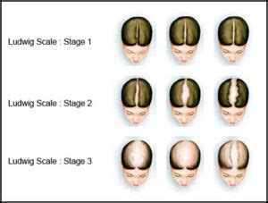 HAIR FALL & HAIR THINNING IN WOMEN – DR A KIRAN KUMAR