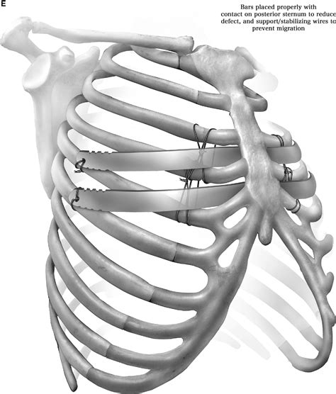 Minimally Invasive Pectus Excavatum Repair (MIRPE) - Operative ...