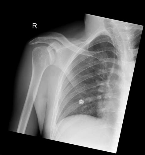 Post Gad: Posterior Shoulder Dislocation