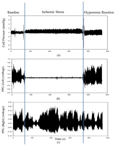 Theoretical and Experimental Study on Assessment of Flow-Mediated ...