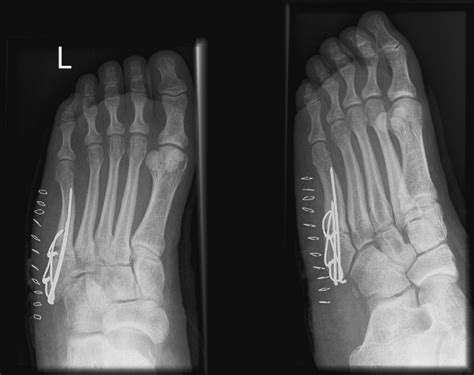 Fractures of the proximal fifth metatarsal: 5th metatarsal fracture ...