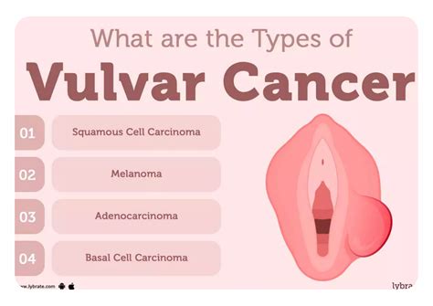 Vulvar Cancer | Services | Bliss IVF - melanoma of the vulva