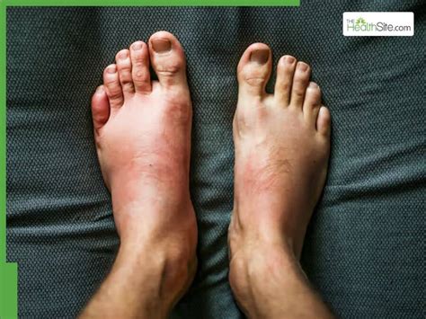 Kidney Failure Symptoms In Legs and Feet: 5 Warning Signs Your Kidneys ...