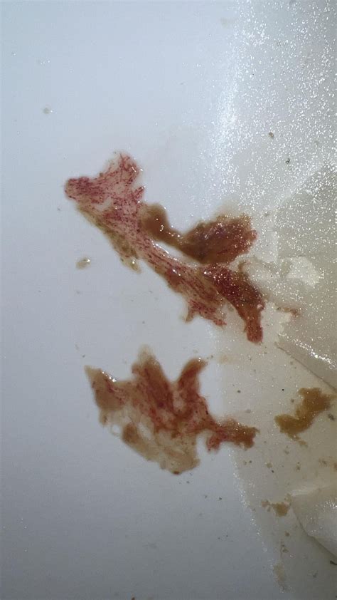 Diarrhea and bloody mucus.. : r/poop