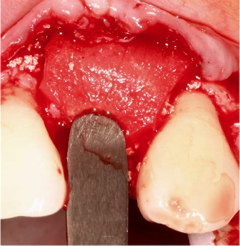 Image result for Dermal Matrix Application