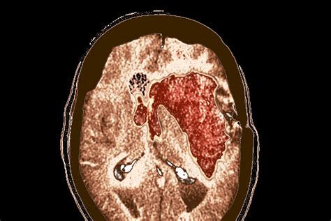 Early Neurological Deterioration in Intracranial Hemorrhage Linked to ...