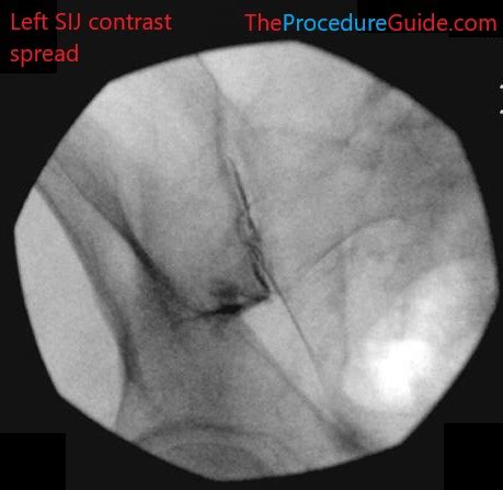 Image result for Shoulder Injection Fluoroscopy