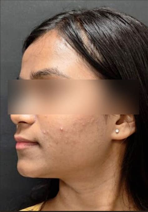 Best Chemical Peel Treatment for Acne in Mumbai & Thane | Top C...