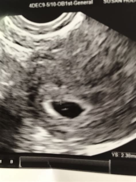 5 Week Ultrasound Pictures