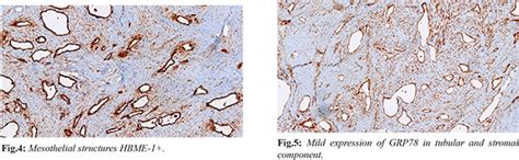 A Rare Peritoneal Adenomatoid Tumor