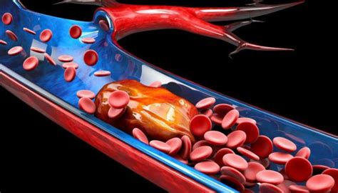 Mechanical Thrombectomy - Dr. BG Muralidhara