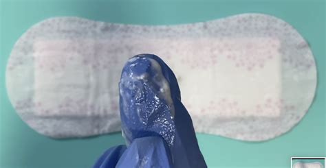 Bacterial Vaginosis (BV) Discharge Pics: Infection Vaginitis - STD ...