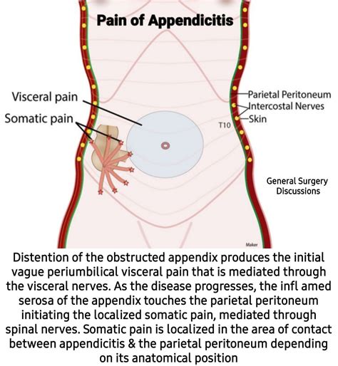 Appendicitis Pain Location Diagram