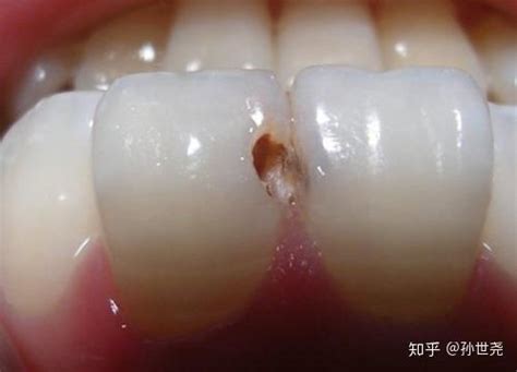 为什么补牙之后牙齿还会出现疼痛？ - 知乎