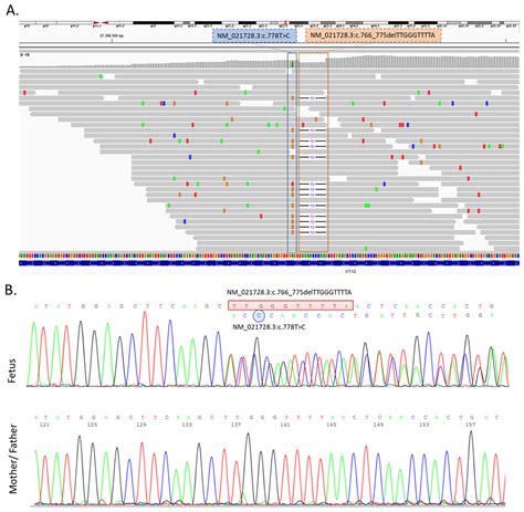 Agnathia-Otocephaly Complex Due to a De Novo Deletion in the OTX2 Gene