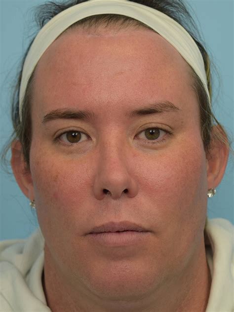 Facial Feminization Surgery Before & After Patient 17 | Face Forward