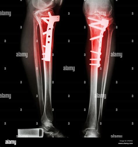 Broken Leg Xray Stock Photos & Broken Leg Xray Stock Images - Alamy