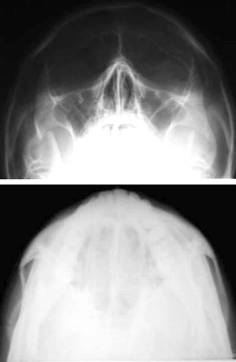 Zygomatic Arch Fracture X Ray View at Alicia Montes blog