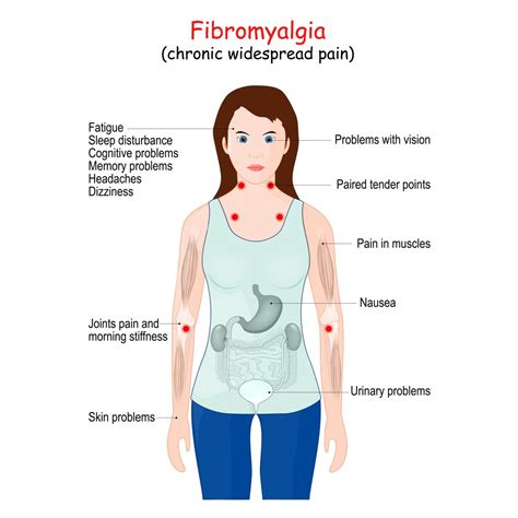 What Is Fibromyalgia | Causes, Symptômes, Traitement, Diagnostic – CREM