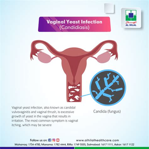 Image Of Genital Yeast Infection