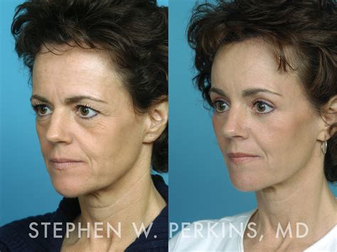 Cheek Augmentation – Indianapolis Facial Plastic Surgeons | Dr. Stephen Perkins, MD