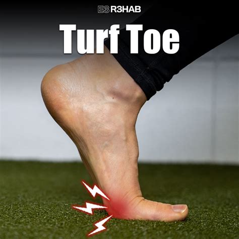 An Overview Of Turf Toe: Causes, Symptoms, And Treatment – HPTYQW