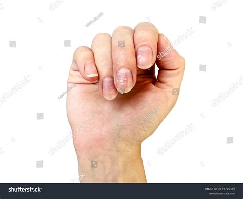 Zinc Deficiency Nails 1,600+ Zinc Nails Stock Photos, Pictures