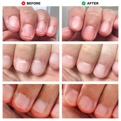 https://www.londontownusa.com/cdn/shop/products/No-Bite---Before-After---All-3-Options-1x1_1400x.jpg?v=1655127613&utm_source=chatgpt.com