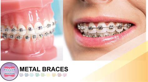 Metal Braces in Sydney | OrthoBoutique