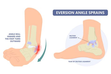 Sprained Ankle Heal Time: Understanding Different Grades of Sprains