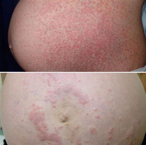 Rash On Abdomen Pregnancy