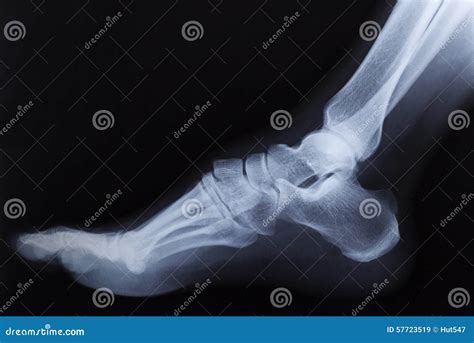 Broken Right Foot Ankle Xray. Stock Image - Image of doctor, broken: 57723519