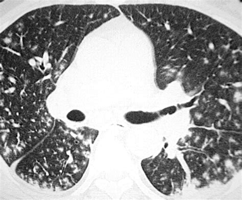 Tree-in-Bud Pattern at Thin-Section CT of the Lungs: Radiologic-Pathologic OverviewRadioGraphics
