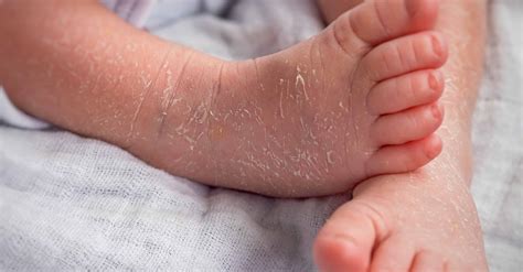 Newborn Skin Peeling - 7 Tips To Manage Newborn Skin Peeling | BellyBelly